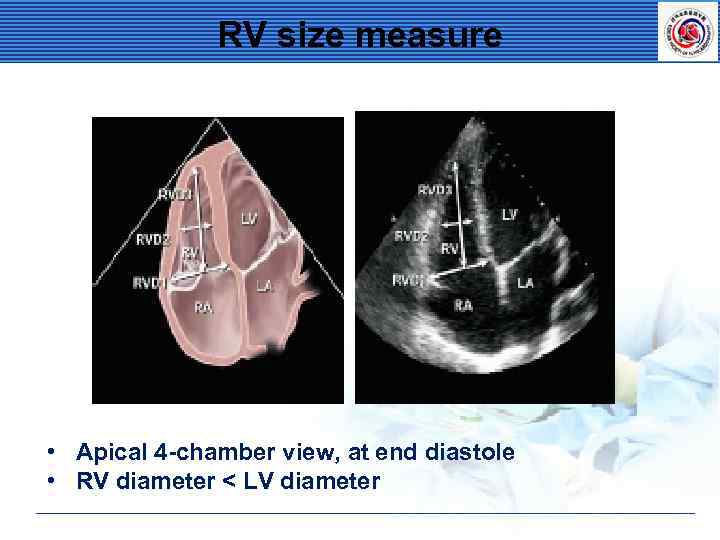 RV size measure • Apical 4 -chamber view, at end diastole • RV diameter