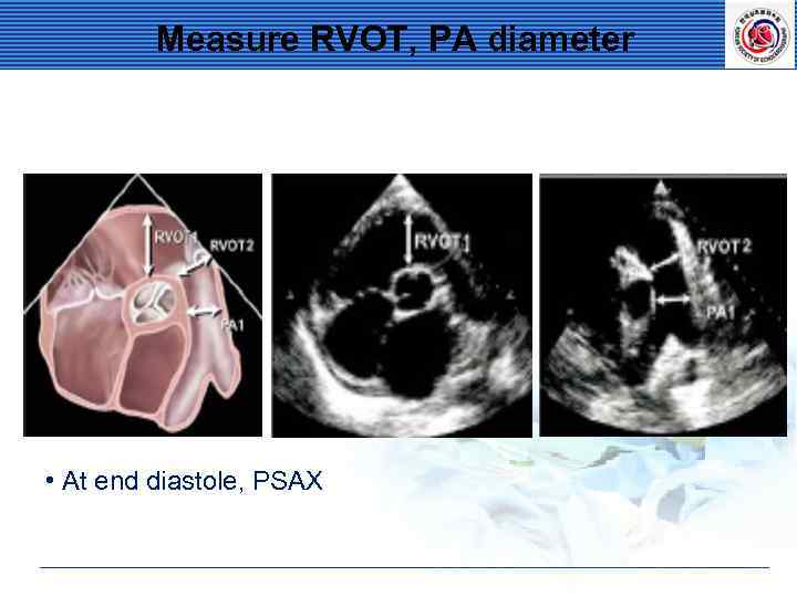 Measure RVOT, PA diameter • At end diastole, PSAX 