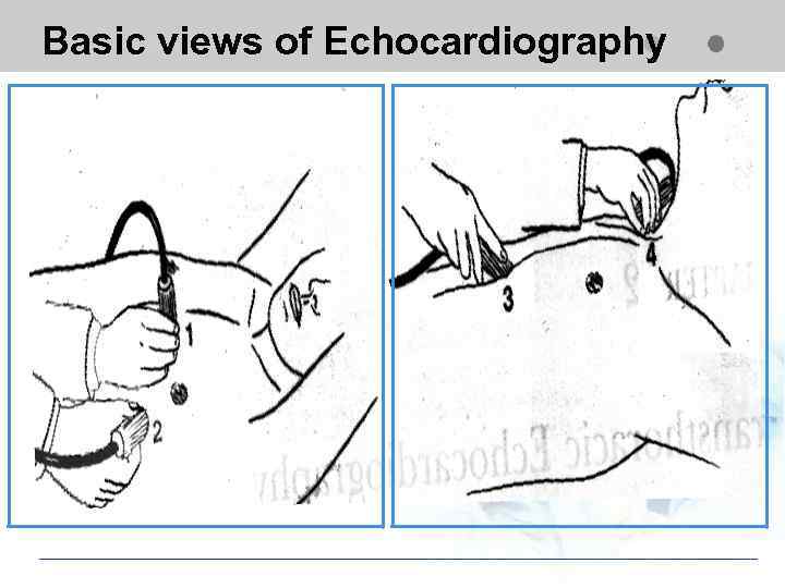 Basic views of Echocardiography Suprasternal view Apical view Subcostal view 