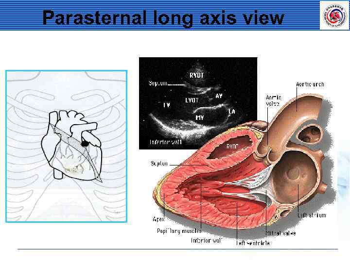 Parasternal long axis view 