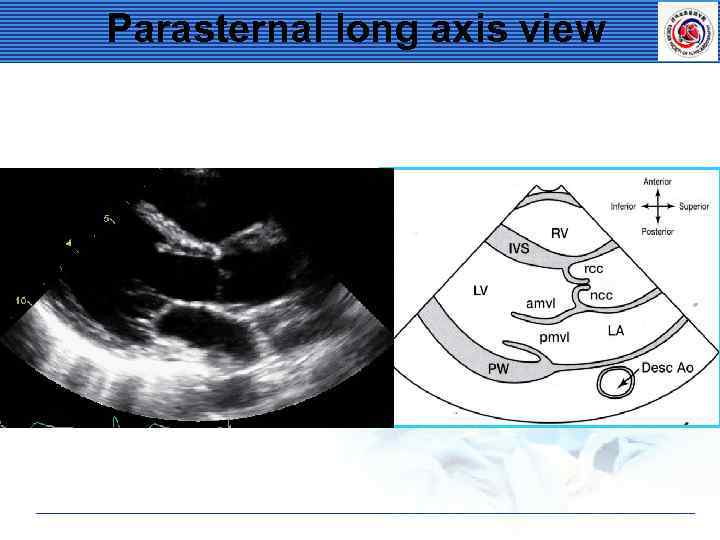 Parasternal long axis view 