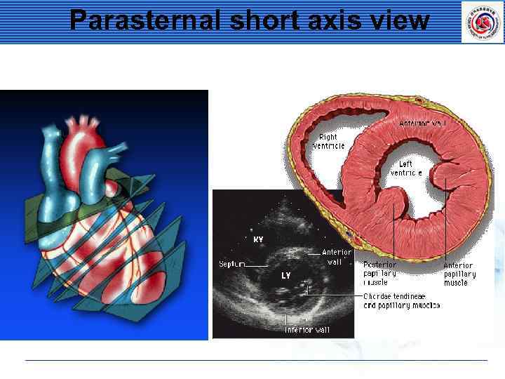 Parasternal short axis view 