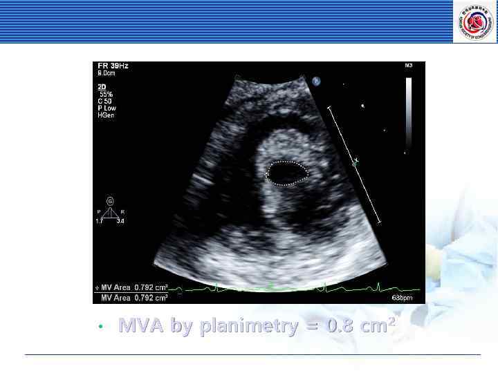  • MVA by planimetry = 0. 8 cm 2 