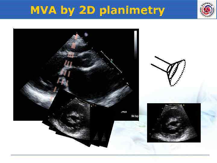 MVA by 2 D planimetry 