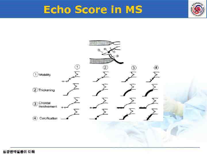 Echo Score in MS 심장판막질환의 이해 