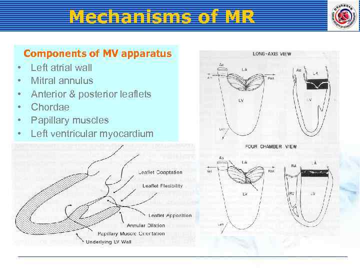 Mechanisms of MR Components of MV apparatus • Left atrial wall • Mitral annulus