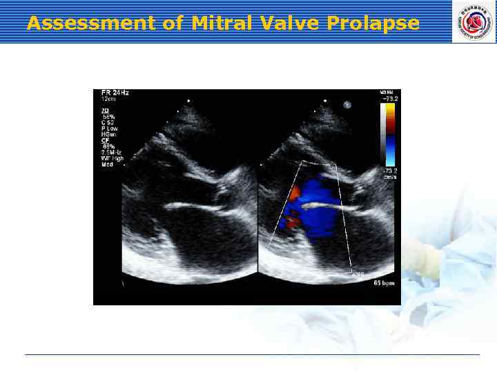 Assessment of Mitral Valve Prolapse 