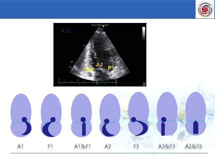 A 2 C P 3 A 1 P 1 A 1&P 1 A 2