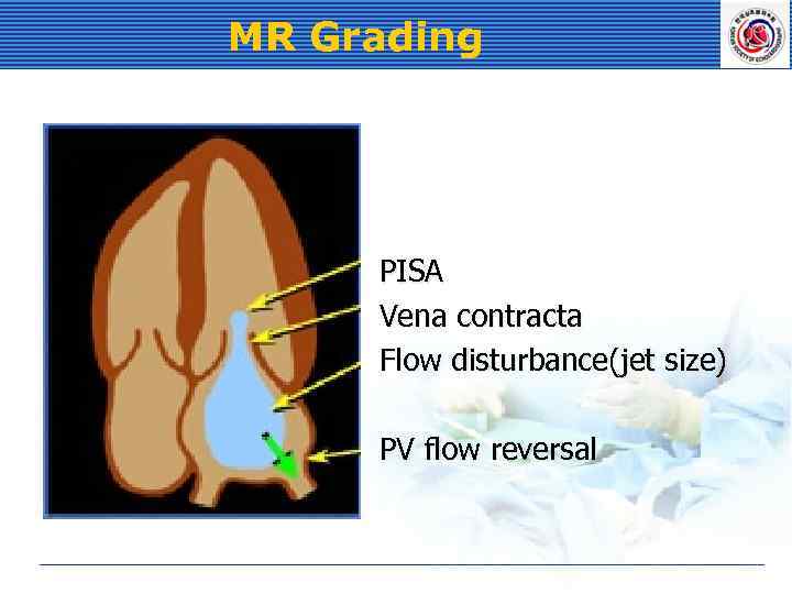 MR Grading PISA Vena contracta Flow disturbance(jet size) PV flow reversal 