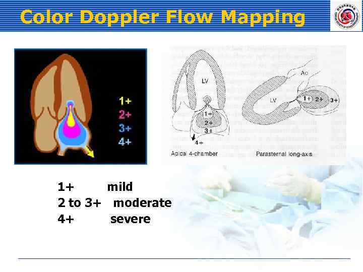 Color Doppler Flow Mapping 1+ mild 2 to 3+ moderate 4+ severe 