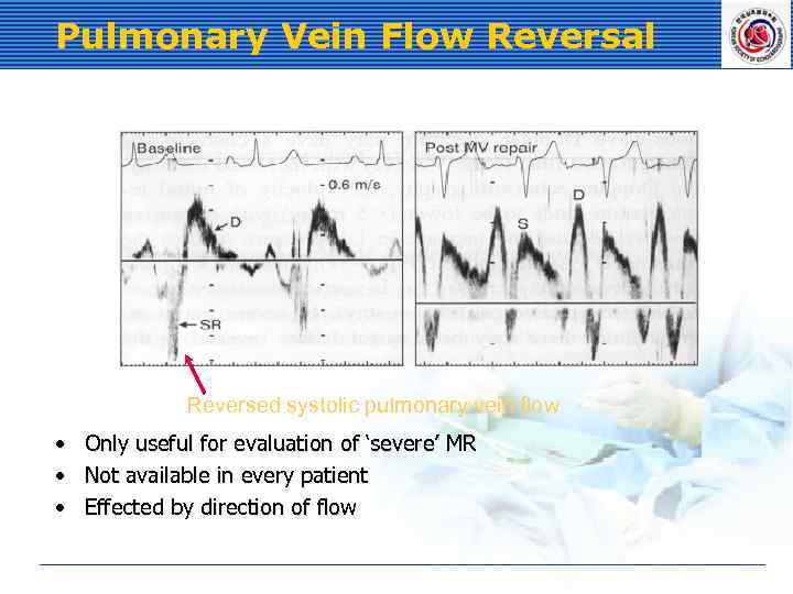 Pulmonary Vein Flow Reversal Reversed systolic pulmonary vein flow • • • Only useful