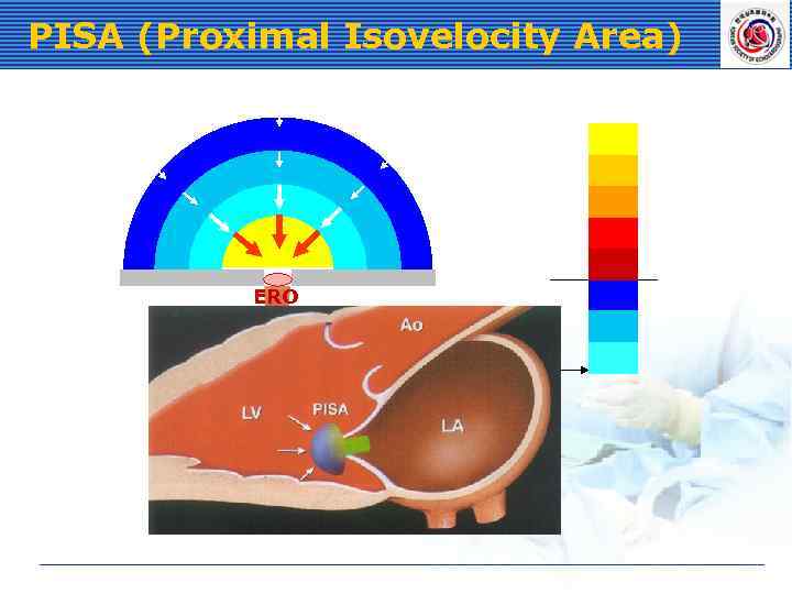 PISA (Proximal Isovelocity Area) ERO Aliasing Velocity (Va) 