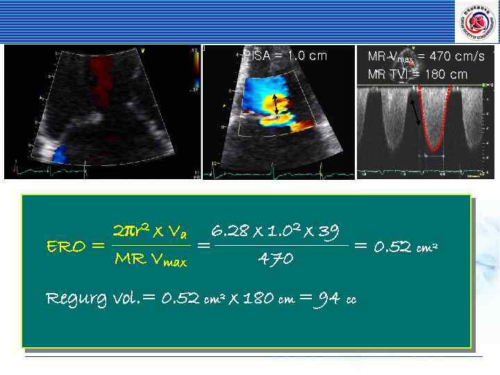 PISA = 1. 0 cm MR Vmax = 470 cm/s MR TVI = 180