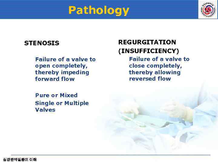 Pathology STENOSIS Failure of a valve to open completely, thereby impeding forward flow Pure