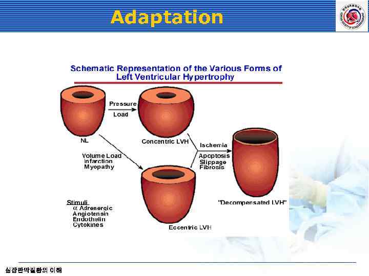 Adaptation 심장판막질환의 이해 