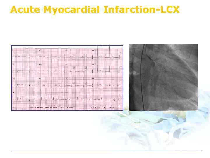 Acute Myocardial Infarction-LCX 