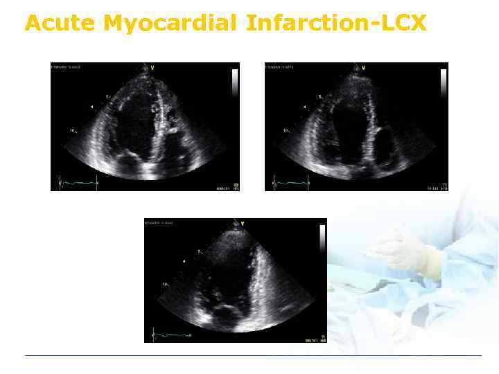 Acute Myocardial Infarction-LCX 