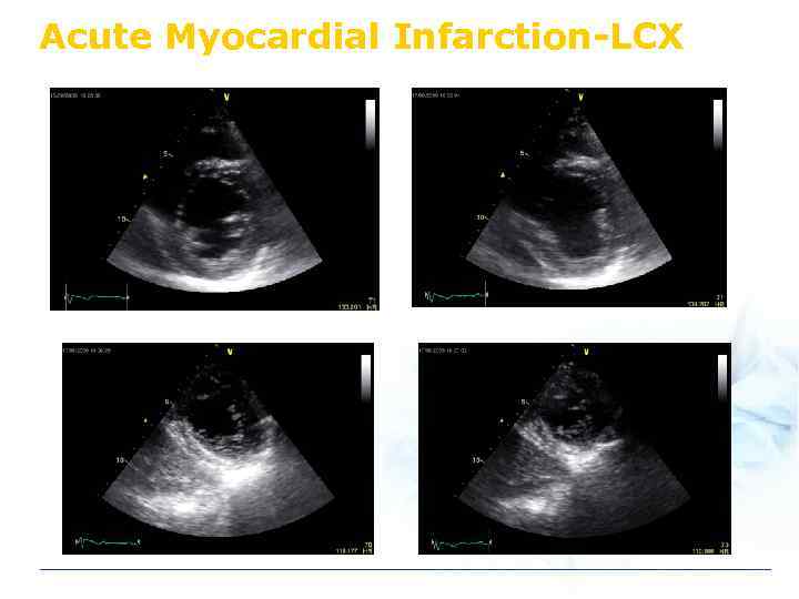 Acute Myocardial Infarction-LCX 