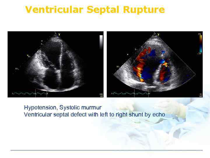 Ventricular Septal Rupture Hypotension, Systolic murmur Ventricular septal defect with left to right shunt