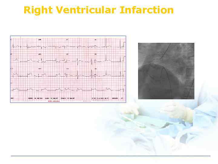 Right Ventricular Infarction 