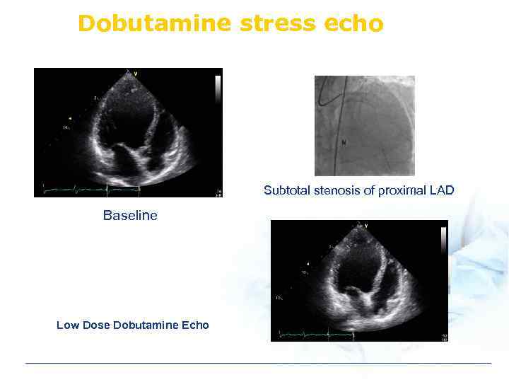 Dobutamine stress echo Subtotal stenosis of proximal LAD Baseline Low Dose Dobutamine Echo 