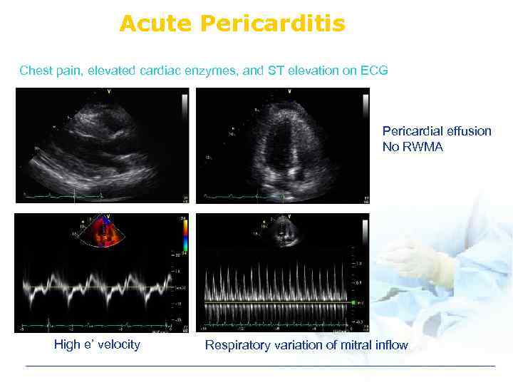 Acute Pericarditis Chest pain, elevated cardiac enzymes, and ST elevation on ECG Pericardial effusion