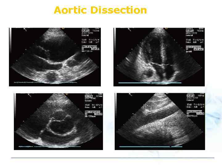 Aortic Dissection 