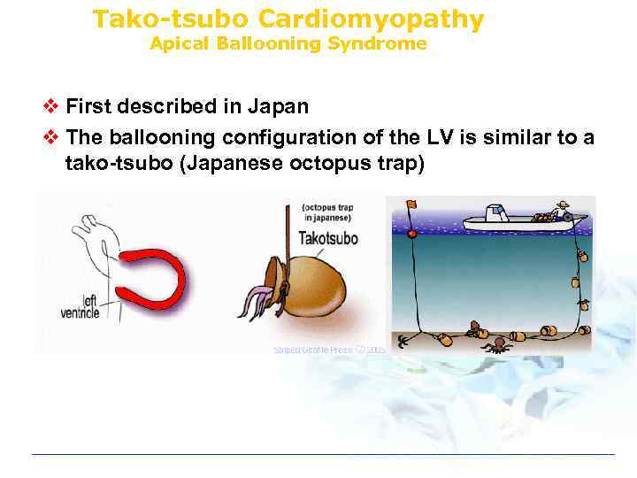 Tako-tsubo Cardiomyopathy Apical Ballooning Syndrome v First described in Japan v The ballooning configuration