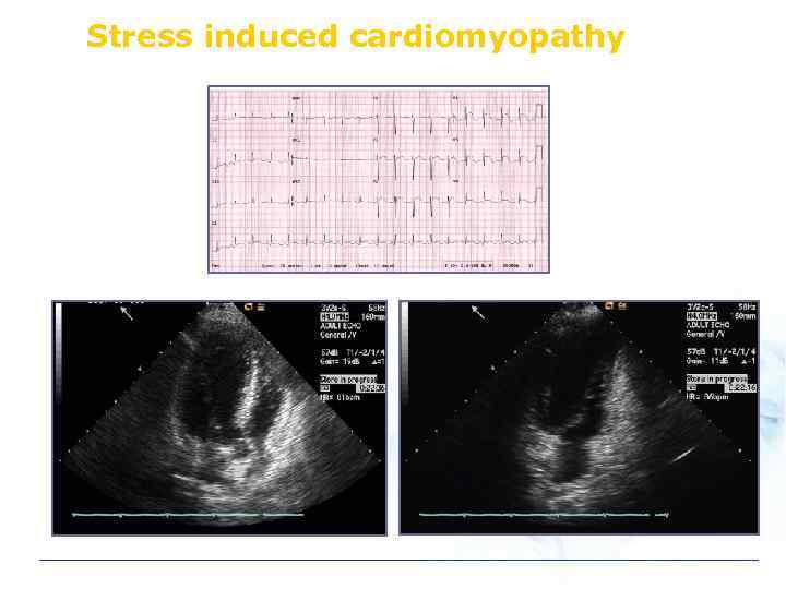 Stress induced cardiomyopathy 