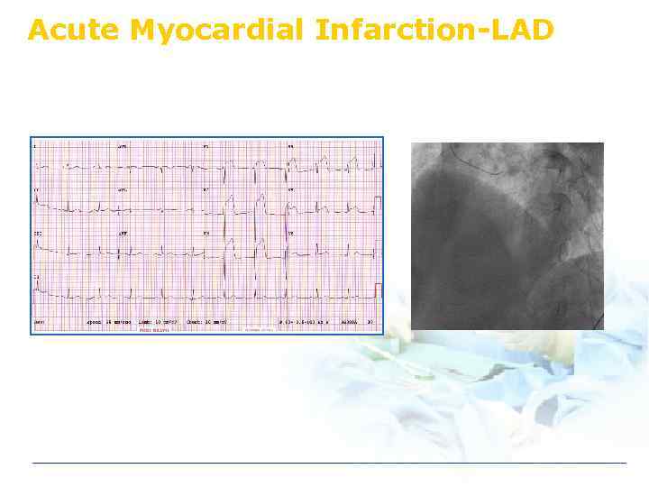 Acute Myocardial Infarction-LAD 