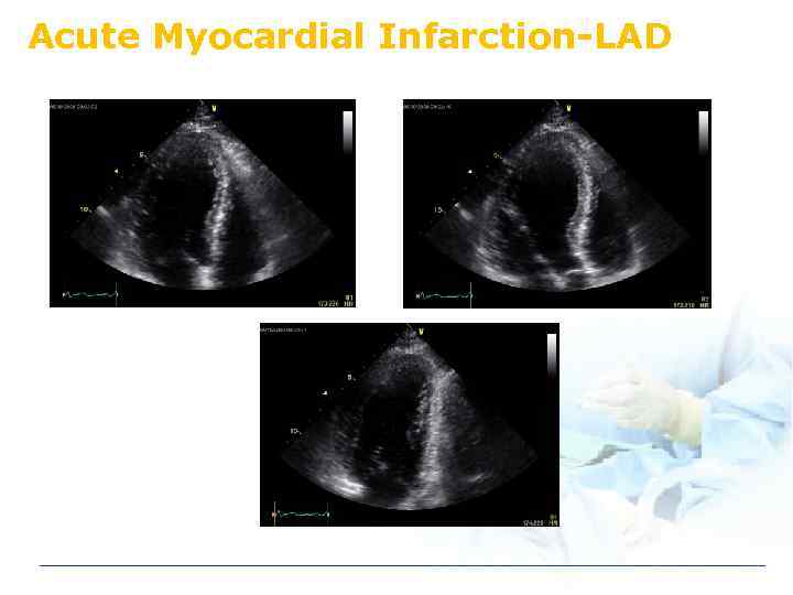 Acute Myocardial Infarction-LAD 