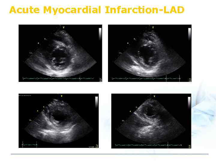 Acute Myocardial Infarction-LAD 