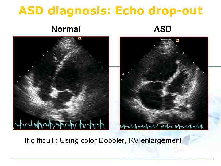 ASD diagnosis: Echo drop-out Normal ASD If difficult : Using color Doppler, RV enlargement