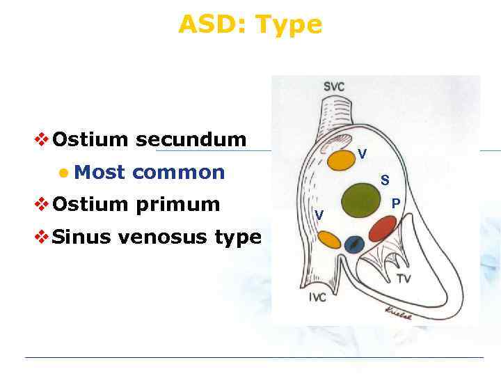 ASD: Type v Ostium secundum l Most V common v Ostium primum v Sinus