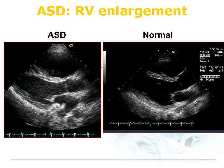 ASD: RV enlargement ASD Normal 