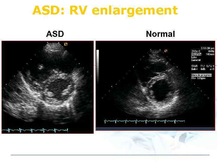 ASD: RV enlargement ASD Normal 