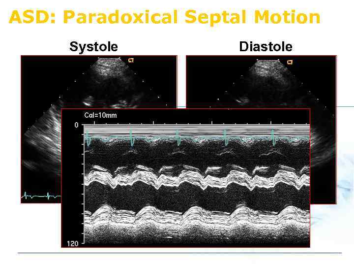 ASD: Paradoxical Septal Motion Systole Diastole 