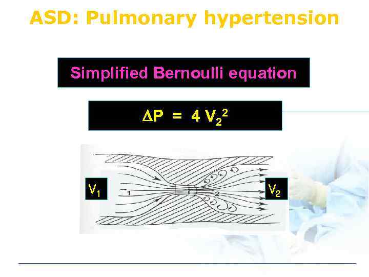 ASD: Pulmonary hypertension Simplified Bernoulli equation P = 4 V 22 V 1 V