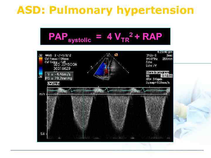 ASD: Pulmonary hypertension PAPsystolic = 4 VTR 2 + RAP 