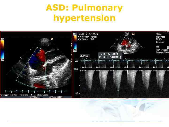 ASD: Pulmonary hypertension 