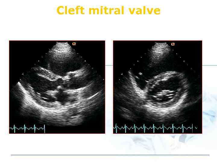Cleft mitral valve 