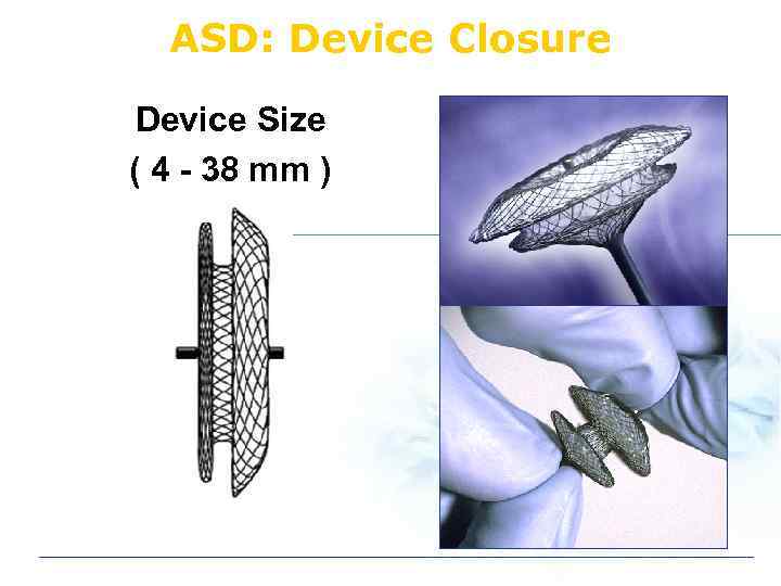 ASD: Device Closure Device Size ( 4 - 38 mm ) 