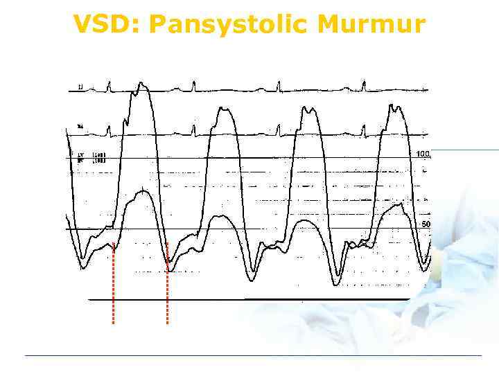 VSD: Pansystolic Murmur 