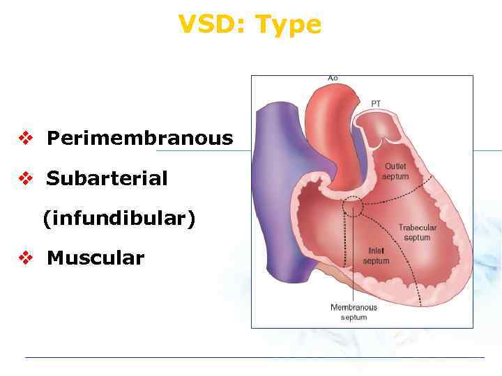 VSD: Type v Perimembranous v Subarterial (infundibular) v Muscular 