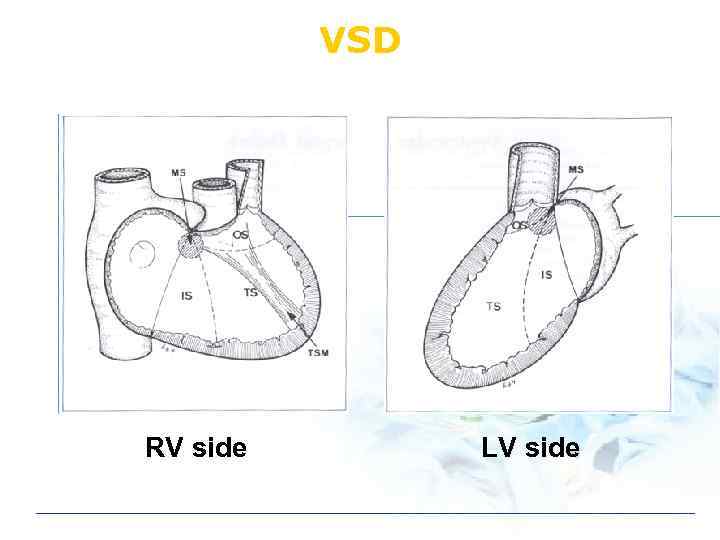 VSD RV side LV side 