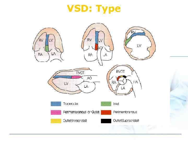 VSD: Type 