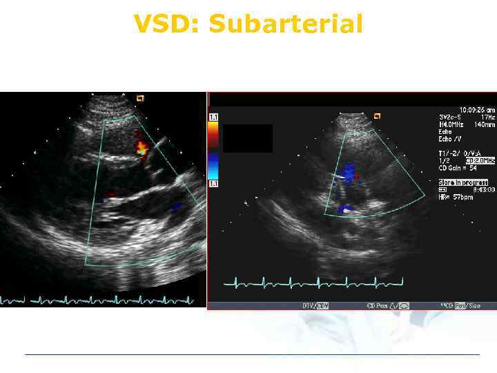 VSD: Subarterial 