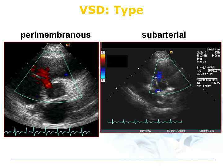 VSD: Type perimembranous subarterial 
