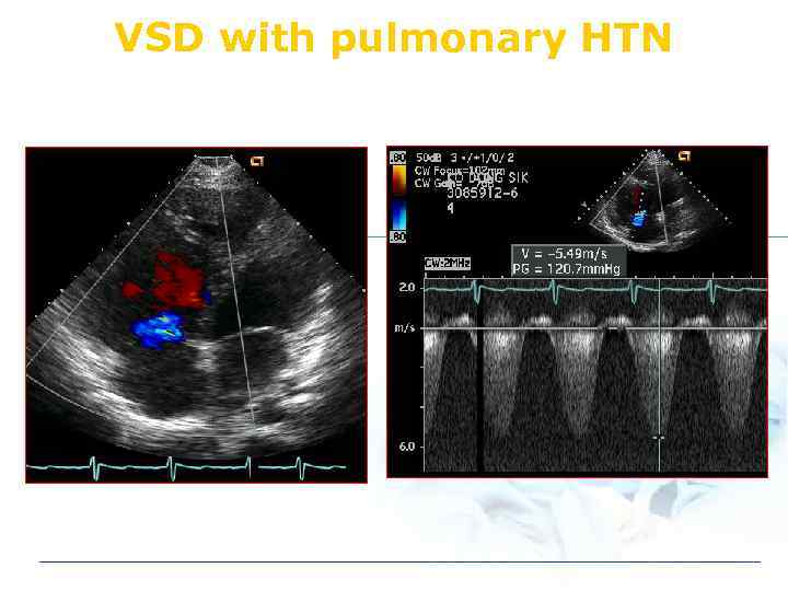 VSD with pulmonary HTN 