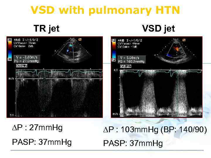 VSD with pulmonary HTN TR jet VSD jet DP : 27 mm. Hg DP